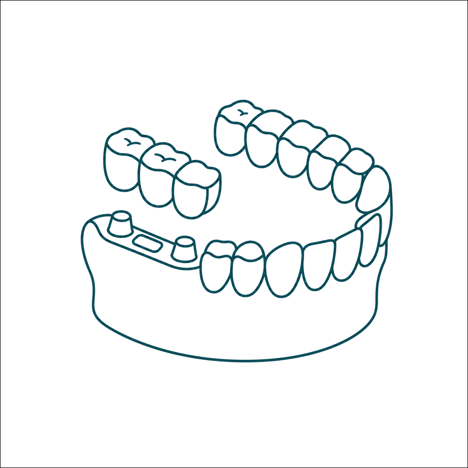 Implant bridges and multiple dental implants