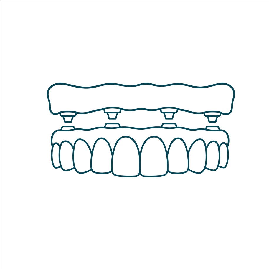 Implant-supported dentures